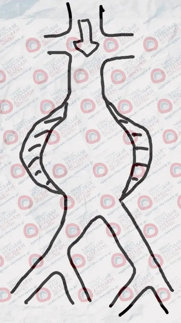 Endovascular aneurysm repair (EVAR) — stent graft inside the aorta
