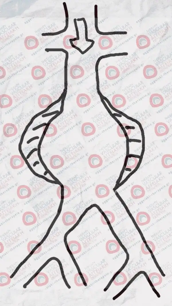 Classic open aortic surgery — replacement with a synthetic graft