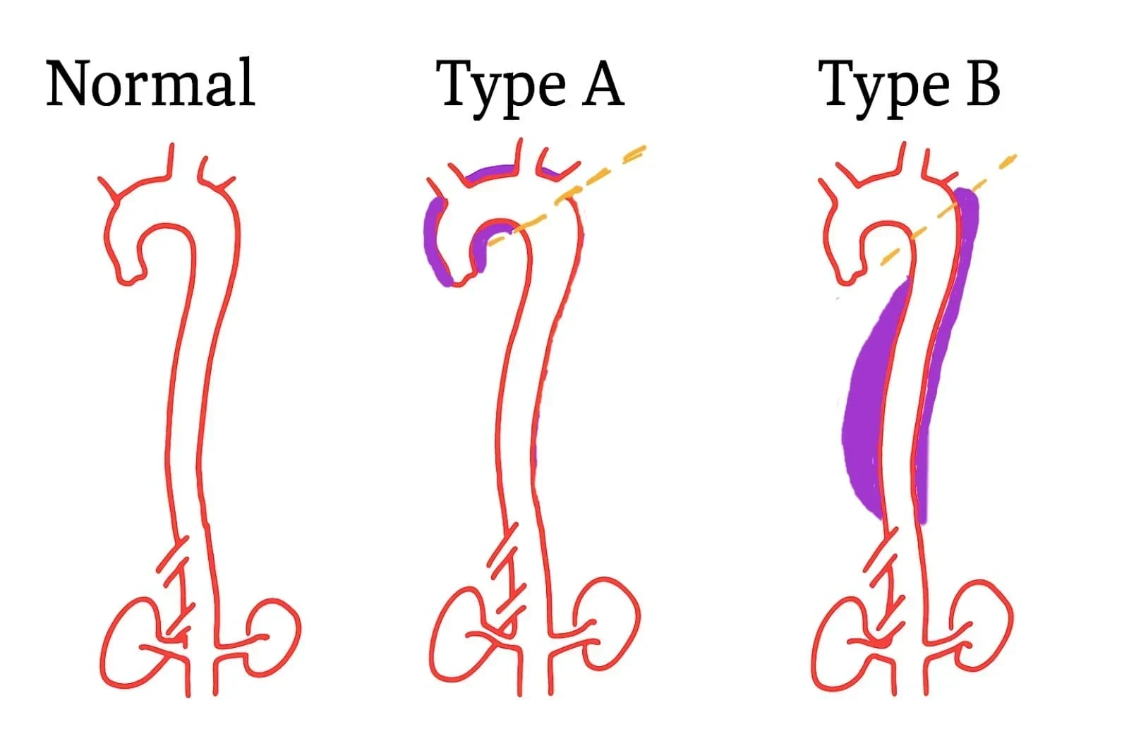 Διάγραμμα τύπων διαχωρισμού αορτής — Normal, Type A και Type B