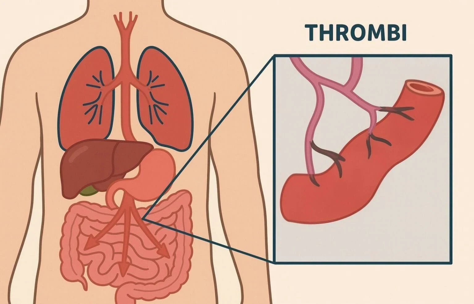 Anatomical illustration of blood clots in the intestines