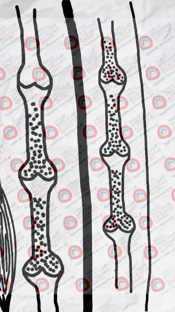 Venous Insufficiency — Valvular Dysfunction